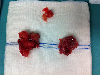 Imej 8: 2 spesimen besar di bawah ialah tonsil kiri & kanan manakala yang kecil di atas ialah tisu adenoid   