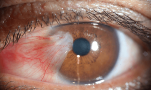 Selaput Mata: Katarak atau Pterygium? – Dr Siti Sarah Seri 