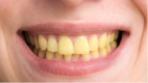 teeth whitening yellow dentin