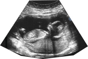 Source: http://www.virtualmedicalcentre.com/health-investigation/ultrasound-ultrasound-scanning-or-sonography-and-doppler/8