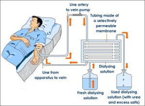 dialysis-process-in-man