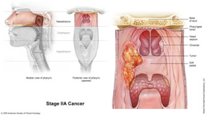 Source: http://www.asiancancer.com/cancer-diagnosis/nasopharyngeal-cancer-diagnosis/