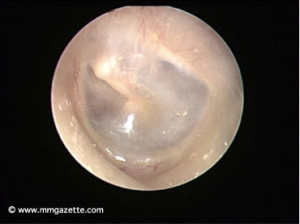 Image 4: endoscopic view of the ear canal showing the ear drum (tympanic membrane) which is sucked inwards due to otitis media with effusion caused by the cancer. Source: Dr. Ahmad Nordin (with permission)