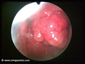 Imej 4: pandangan endoskopi hidung menunjukkan ketumbuhan berbentuk sebagai kobis bunga (cauliflower) di bahagian kiri nasofarinks pesakit (bahagian kanan gambar). Bahagian kanan nasofarinks pesakit normal Sumber: Dr. Ahmad Nordin