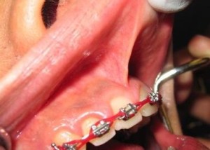 Source: http://www.monadnockorthodontics.com