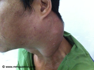 Imej 3: left neck massive cervical lymphadenopathy Sumber: Dr. Ahmad Nordin 