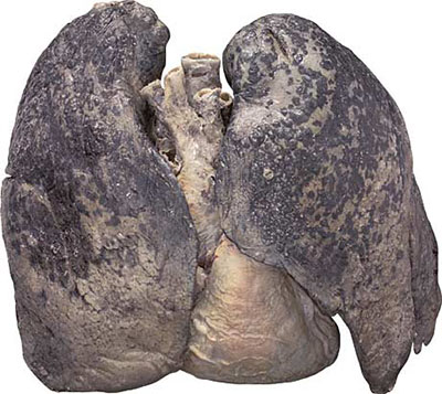 BODIES_smokers_lungs