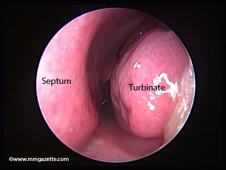 Image 1 normal turbinate