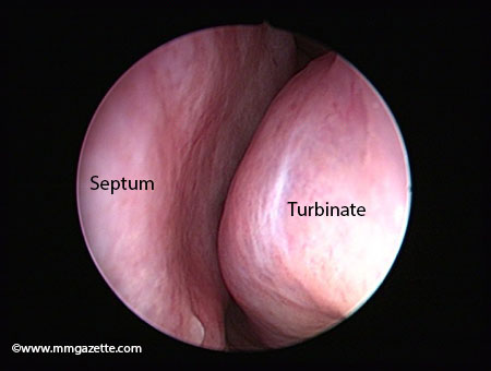 Image 2 allergic nasal endoscopy