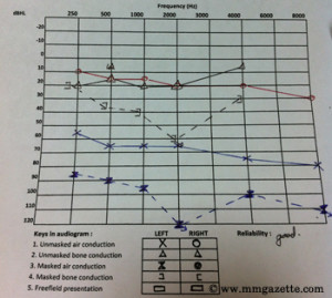 The audiogram showing the plotted points done during the test and will indicate the degree of hearing loss