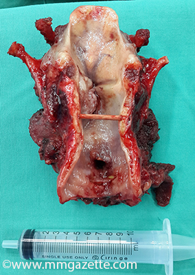 Laryngectomy specimen