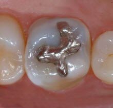 Amalgam Restoration Source: http://dentistryandmedicine.blogspot.com/