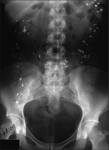 Bowel transit study