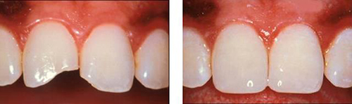 Composite filling Source: http://www.intelligentdental.com