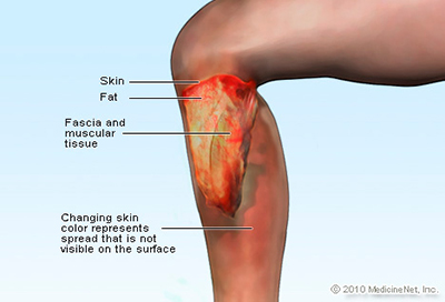 Sumber: www.medicinenet.com