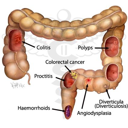 Source: http://colorectalsurgeonssydney.com.au