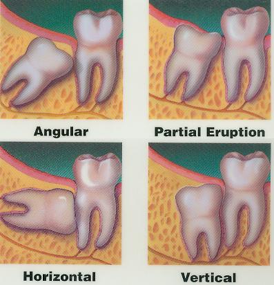 Sumber: www.hanoverdentalclinic.ca