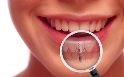 Source: www.dentalimplantcostarica.com