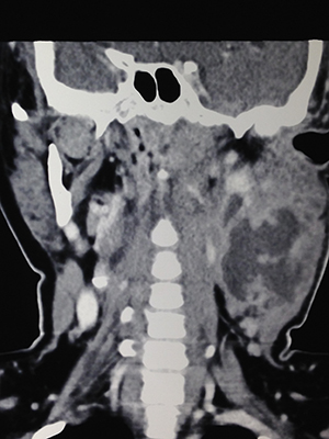 Image 2: Collection noted at the left neck (irregular black shadow at the centre of the swelling- at the right middle side of image)