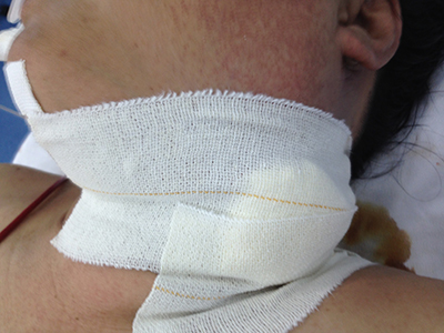 Image 11: Neck dressing applied at end of procedure.