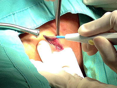 Image 5: Dissection with diathermy.