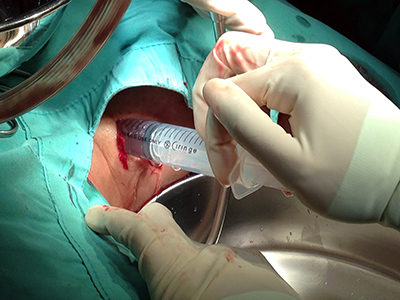 Image 9: Flushing of abscess cavity.