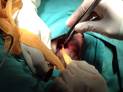 Image 10: Packing of abscess cavity with ribbon gauze. 