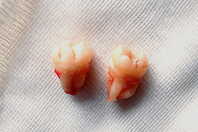 Kesan Kehilangan Gigi Kekal – Dr Anis Ezrina  The 