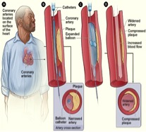 Picture 2:- Cartoon depiction of coronary angioplasty where a balloon (L) and a stent (R) is inserted to widen the narrowed blood vessel. Image source; National Heart, Lung and Blood Institute & ADAM Images 