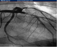 Picture 5:- How a coronary angiographic film looks like.