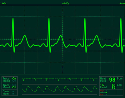 ECG-1024x801