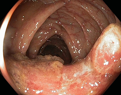 ENDOSCOPICHNA-KARTINA-RAKU