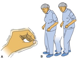 Figure 1: A) Pill rolling tremor B) Stooped posture with shuffling, hesitant gait 
