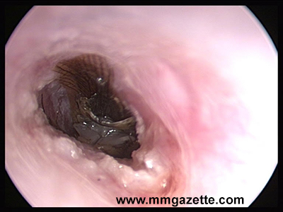 Image 2: Endoscopy view of the cockroach in the ear canal