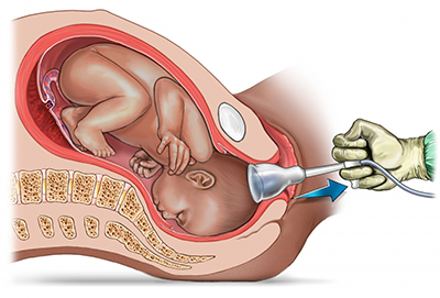 vacuum-extraction