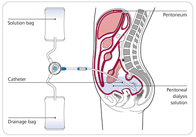 Peritoneal Dialysis