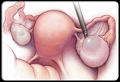 onarian-cysts