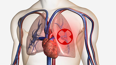 Pulmonary-embolism