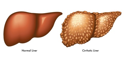 Figure 3: Comparison between a normal liver to a cirrhotic liver – notice the multiple rounded growth developing on the liver surface; these are irreversible fibrotic liver tissues (courtesy of www.bahola.co)
