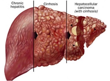 Figure 2: From ongoing inflammation (chronic hepatitis) to cirrhosis (advanced state of fibrosis) to hepatocellular carcinoma (liver cancer as a complication; courtesy of http://uct-clinic.com)