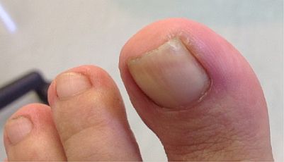 ingrown-toenail-surgery-stage1