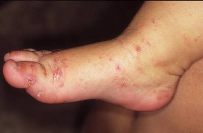 child-foot-scabies