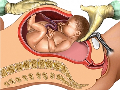 csection-diagram-450x338