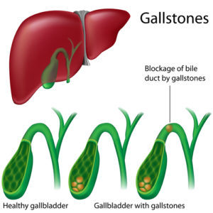 symptoms-gallstones