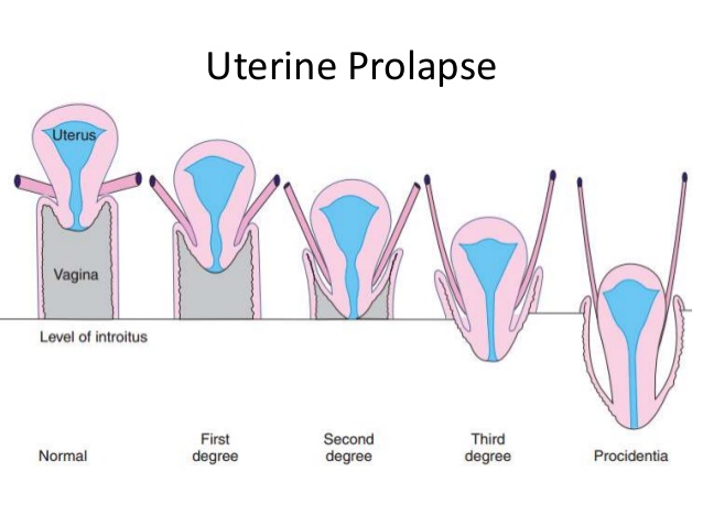 In malay uterus Endometriosis