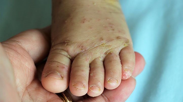 Scabies in malay