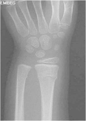 wrist torus fracture